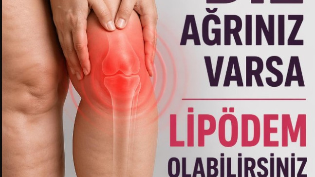 Lipödem Diz Ağrısının Gizli Nedeni Olabilir